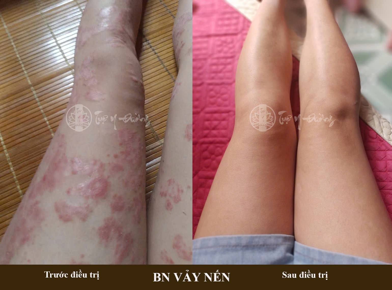 Phản hồi tích cực của bệnh nhân điều trị vảy nến tại Tuệ Y Đường