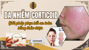 Da nhiễm corticoid - Biện pháp phục hồi an toàn bằng thảo dược