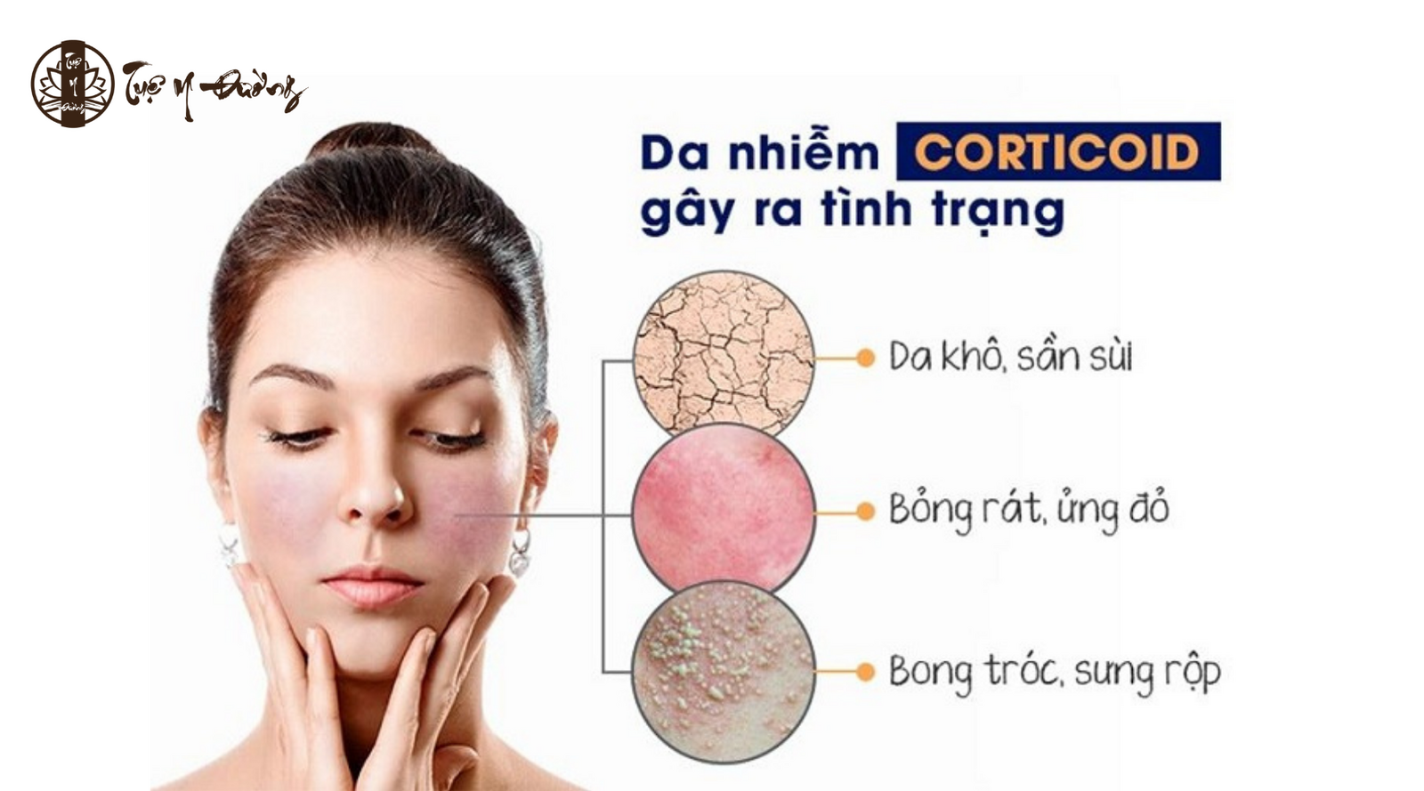 Các giai đoạn da nhiễm Corticoid