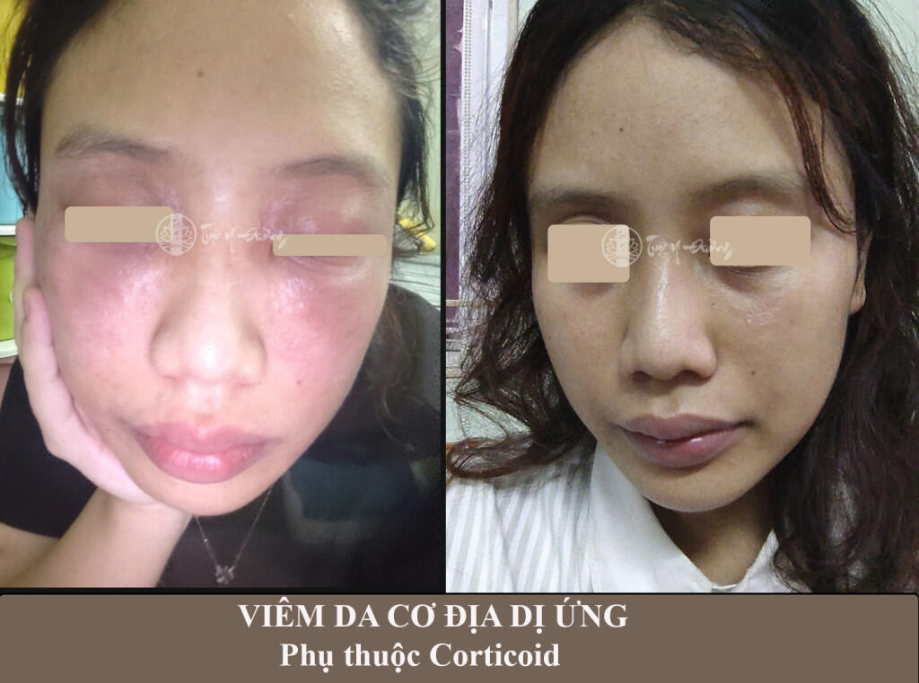 Phản hồi trực tiếp của bệnh nhân khi điều trị da bị viêm nhiễm corticoid tại Tuệ Y Đường