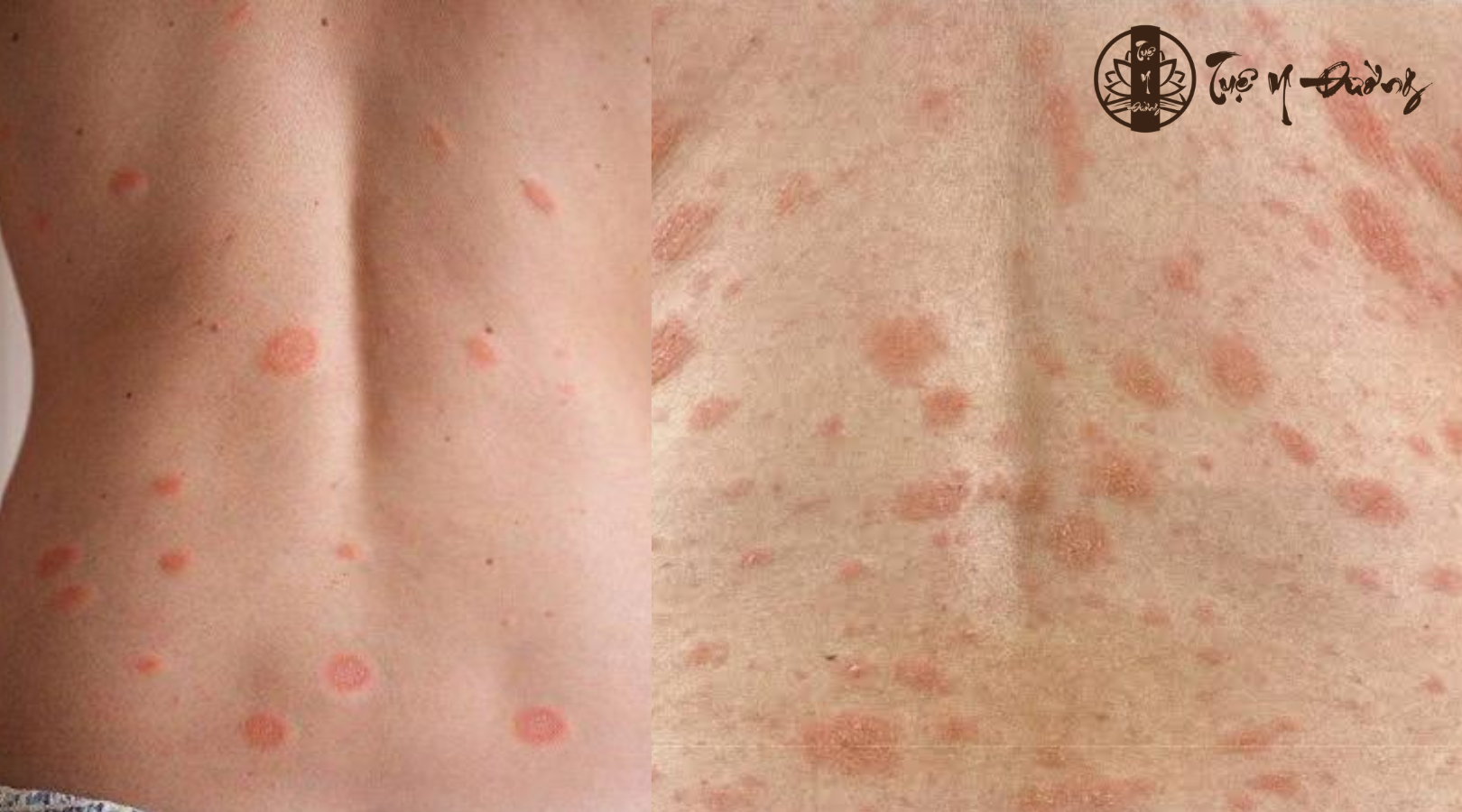 Dấu hiệu điển hình của bệnh vảy phấn hồng