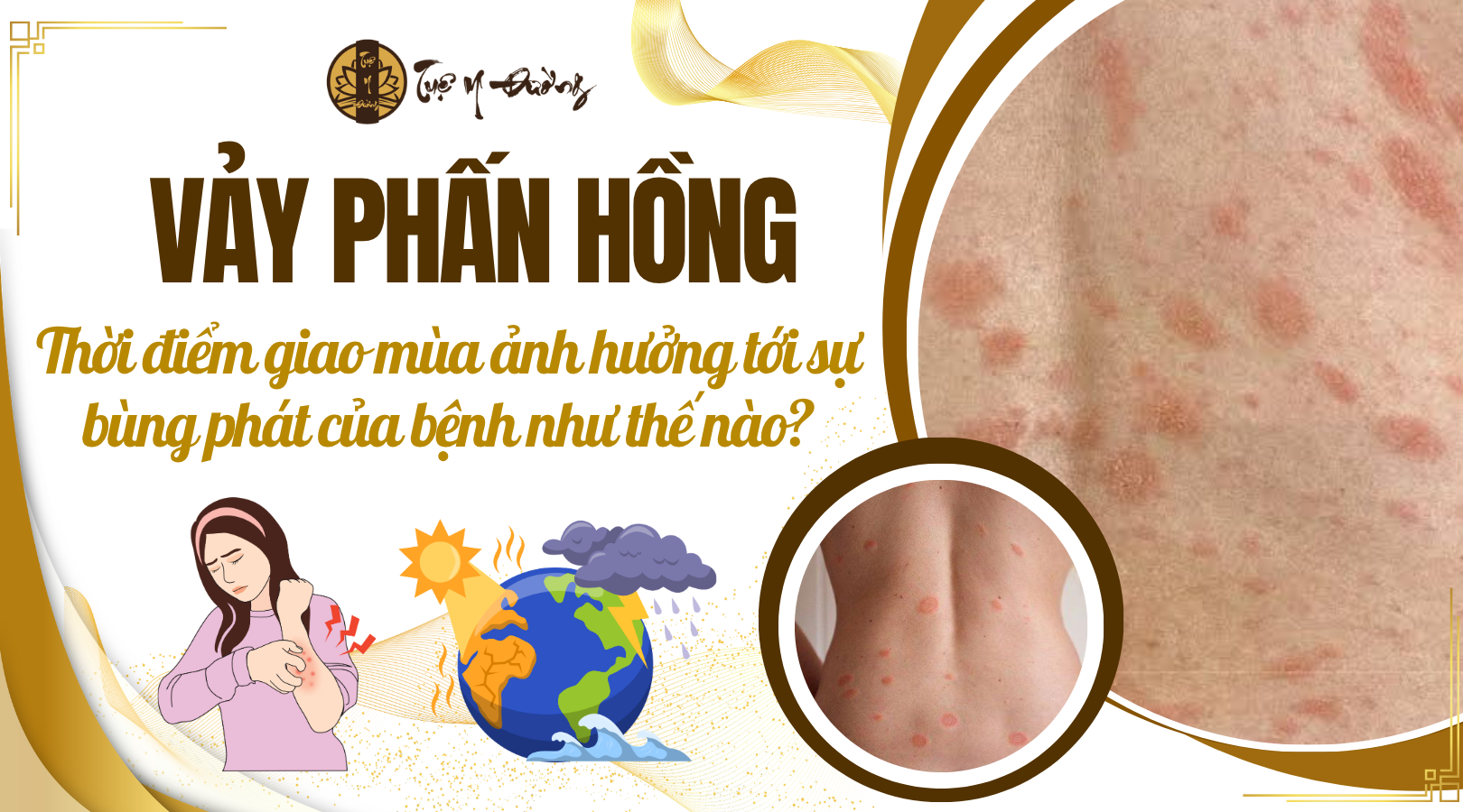 Vảy phấn hồng - thời tiết giao mùa ảnh hưởng đến vảy phấn hồng như thế nào